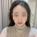 청담 리무드 닥토필, 볼콜드플라즈마 후기: 강남에스테틱·청담에스테틱·청담피부관리 전후사진까지!