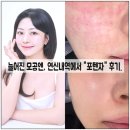 (내돈내산) 연신내 피부과에서 모공축소 포텐자 받은 솔직후기!