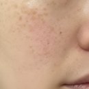 높고 맑은 소리, 소금 - 기초편 | 기미제거패치 내돈내산 효과 및 사용법, 2개월 찐후기