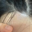 톡스앤필의원명동점 | [톡스앤필 명동]3자이마 탈출 헤어라인 제모(2회차 완료) 내돈내산 후기