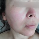 포항 리턴에이징 애기속살로 돌아가기 버닝필 2회 경과후기