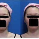 [혜화] 아름턱한의원 30회 후기