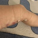 고운하지흉부외과의원 | 하지정맥류 고주파 수술 후기(Feat.고운하지흉부외과)