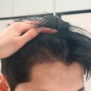 아주꼬매헤어 | 남자 절개 2200모 M자 모발이식 4개월차 후기