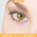 눈이 노랗게 이유 뭘까? 눈 흰자 노란색 원인 성인 황달 포함 이미지