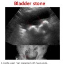 Bladder stone 이미지