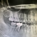 임플란트하려고 하는데 질문이있어요 이미지