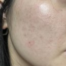 삼덕동 피부관리샵 &lt;인포레스킨&gt; 내돈내산, 주사피부염 완치
