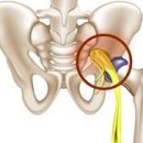 좌골신경통 이미지