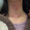 개이뻐 | [팔자주름 시술 귀족침 후기]하루만에 이뻐짐 효과 대만족!!(가격,효과,전후사진,부작용 +목주름리프팅...