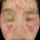 송파다이아튼튼의원 | 주사피부염 피부과 송파 전문의 후기