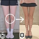회원청구_9개월_1.6 | 오다리 교정 깔창 효과 있나요? 수술 만이 답인가요? 의사 선생님이 그러던데요...