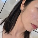 오름한의원 | 홍대 해율한의원 오름테라피 마지막 후기 여드름흉터관리 변화