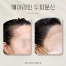 광주 헤어라인 문신 콤보 후기 / 탈각 통증 샴푸 관리 주의사항