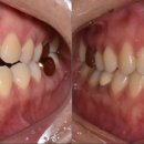 혜정치과의원 | 5월달의 교정후기 감사합니다💜