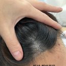 현헤어라인 이미지