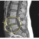 척추 분리증 이미지