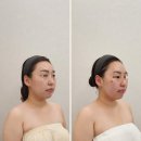 남구-4 | 울산 남구 피부관리 아뜰리에드스킨 테라노바 4회차 후기 얼굴자체 작아져