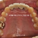 나의미소치과의원 | 관양동 치과 오래된 앞니 앞니 브릿지 2차 우식, 임플란트로 재건한 치료 과정