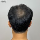 레이븐스칼프 이미지