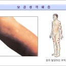 모공성 각화증 이미지