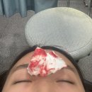 프리마(Prima)성형외과의원 | 화곡역 프리마피부과 흉터치료 내돈내산 진피재생술 1차 후기!