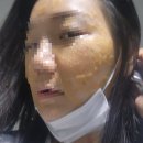관문제일약국 | 코코리젠 내돈내산 기미 잡티 흑자 제거 과정 일주일 한달 후기