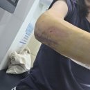 달려라병원 | 왼팔꿈치 골절 수술 후 재활기간, 2개월째 재활 도수치료 받는 중