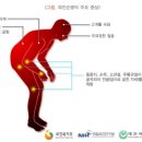 파킨슨병 환자, 뇌심부자극(DBS) 수술로 운동이상 증상 완화 이미지