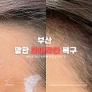 까까바헤어 - 서구 | 망한 헤어라인 되살리기 SMP 제거후 헤어라인 반영구 내돈내산 후기