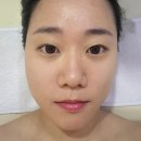 필 | 화정피부관리, 다솜에스테틱 화정점 여드름필 후기