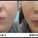 강남미의원 | 울쎄라수면마취 통증 효과 솔직후기