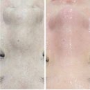 점찍다 | 안양 인덕원 피부관리 마음에점을찍다 안양점 마이크로젯 리프팅 후기✨