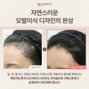 수헤어라인 | 여성헤어라인교정 고민된다면? 리얼 헤어라인교정후기 체크