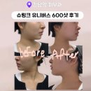 덕인의원 | 강남역피부과 ㅣ 슈링크유니버스 600샷 후기