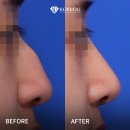 코비쥬 의원 | 매부리코, 휜코 교정 2주차 후기 비중격교정부터 절골까지 (코비쥬의원)