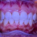 남플란트치과의원 | [내돈내산]신정네거리 남플란트 치과 치아미백+충치치료 후기