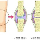 고관절 통증 원인, 일과성 고관절 활액막염 증상 및 치료 (아이 다리 절뚝거림) 이미지