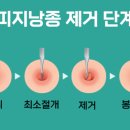 영화실비 | 흉터 없는 완치! 피지낭종 원인 제거 방법과 제거 후기. 실비 환급