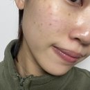 서울에스와이피부과의원 | 선릉피부과 쥬베룩 스킨부스터 2cc 효과 유지기간 통증 후기