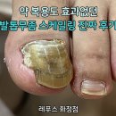 발톱무좀 병원약 종류, 병원약 복용 대신 무좀균 스케일링 후기