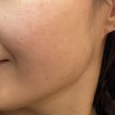 본디성형외과의원 | 내시경귀뒤 사각턱(피질골 제거 포함) + 근육절제 (상담 후기)