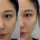 미미썸의원 상담 필러 상담 후기｜눈밑고랑 필러로 다크써클 인상 개선 + 사각턱보톡스