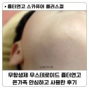 메디샵 | 스카퓨어플러스겔 흉터연고추천 / 아이부터 어른까지 온가족이 쓰는 흉터연고후기