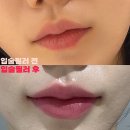 맑을아 의원 | 노원 피부과 맑을아의원 :: 입술필러 전&amp;후 레알 찐 TMI후기 / 수입필러,가격,시술과정
