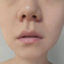 신세계안피부과의원 | 신사피부과 즉흥으로 가서 볼뉴머 리프팅 400샷 받고 신세계 경험 후기
