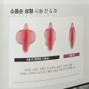 아침별 남부&여성의원 | 대구 여의사 산부인과 소음순수술 상담부터 수술까지 와이레이디 여성의원