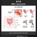 충수염 2일차
