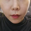 센트럴파크역 송도성형외과 고주파리프팅 텐써마300샷 후기(통증,가격,부작용 등)