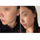 엘이디세상 | 강남 색소치료 피부과 추천, 코어레이저 후기 (잡티 토닝, 제네시스, 루비, 뷰레인 효과 부작용 딱지 등)
